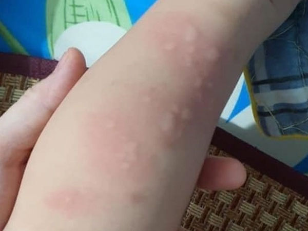 Mẹ run rẩy phát hiện con 15 tháng tuổi nhiễm giun đũa chó và giun lươn