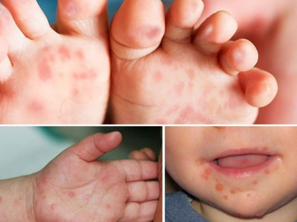 Dấu hiệu trẻ mắc tay chân miệng trở nặng, cha mẹ cần chú ý kẻo 'hối không kịp'