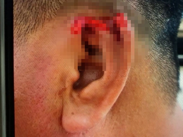 Phát hiện ngoại tình, 'vợ lớn' cắn đứt tai chồng ngay giữa buổi tiệc