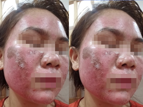 Mặt bỏng rát, bong tróc như da rắn sau khi bôi thuốc tại spa, cô gái trẻ hoảng hốt cầu cứu bác sĩ