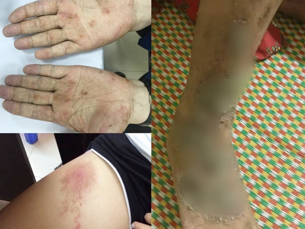 Bị ngứa 10 năm tưởng viêm da cơ địa, hóa ra ấu trùng giun đũa chó mèo 'đào hầm' trong da