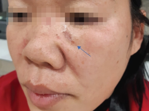 Vì sao ung thư da lại tăng vào mùa hè?