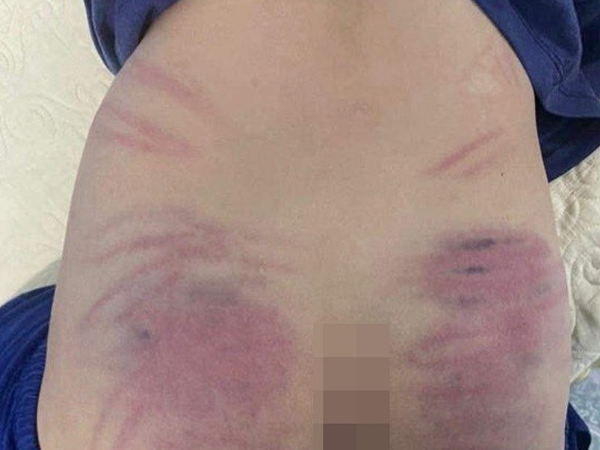 Hà Nội: Bé 9 tuổi chậm phát triển nghi bị cô giáo bạo hành dã man