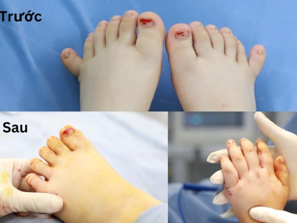Hiếm gặp: Bé gái ở Quảng Nam có 12 ngón tay, 12 ngón chân