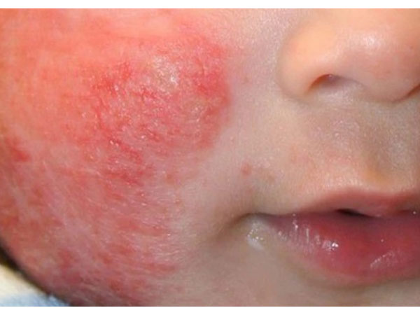 Trẻ bị viêm da cơ địa nên mặc quần áo ra sao để tránh kích ứng?