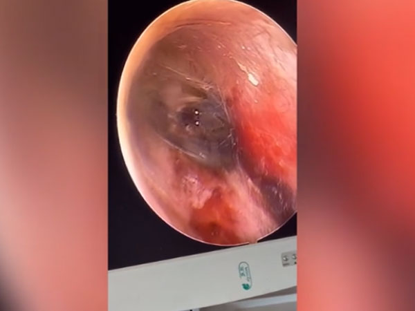 Video: Nhện chui vào tai người giăng mạng