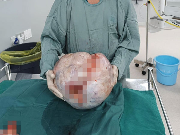 SỐC: Người phụ nữ mang khối u buồng trứng 15kg