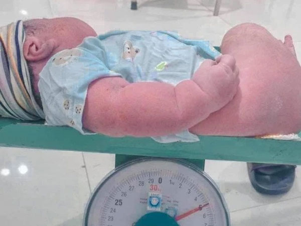 Sản phụ Nghệ An sinh thường con thứ 6 là bé trai nặng 5kg
