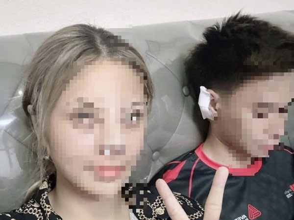 Xôn xao thông tin cô gái nâng mũi bằng sụn tai của bạn trai, bác sĩ nói gì?
