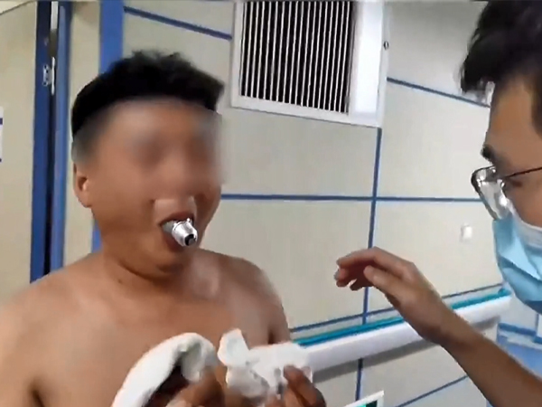 Hồi hộp theo dõi bác sĩ giải thoát chiếc bóng đèn 'mắc kẹt' trong miệng người đàn ông
