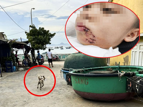 Đi du lịch cùng gia đình, cháu bé 3 tuổi bị chó cắn phải khâu 32 mũi