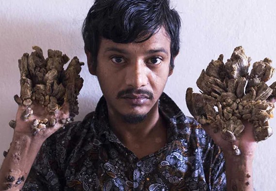 Ám ảnh 'án chung thân' trong chính cơ thể mình của người cây Bangladesh
