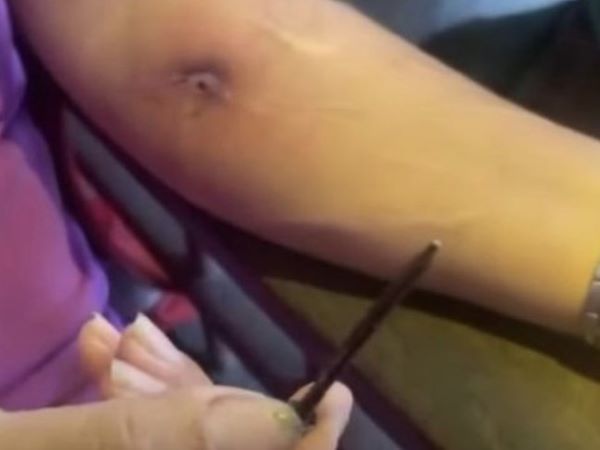 Thực hư chuyện hàng chục chiếc đinh 'mọc' ra từ cánh tay người phụ nữ ở Quảng Ngãi