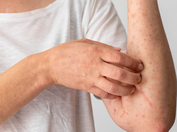 Thời tiết thay đổi khiến nhiều người tái phát viêm da cơ địa, bác sĩ khuyến cáo cách xử lý