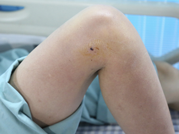 Bị gà trống mổ vào chân, người phụ nữ sốt 40 độ phải nhập viện cấp cứu