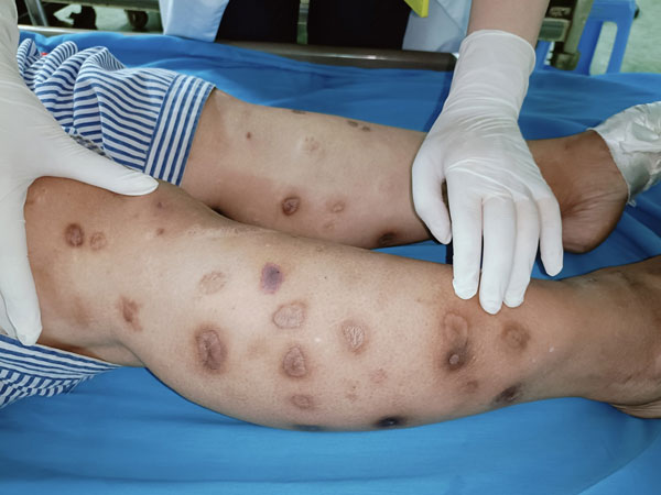 Người phụ nữ gặp biến chứng nguy hiểm do tự tiêm canxi tại nhà