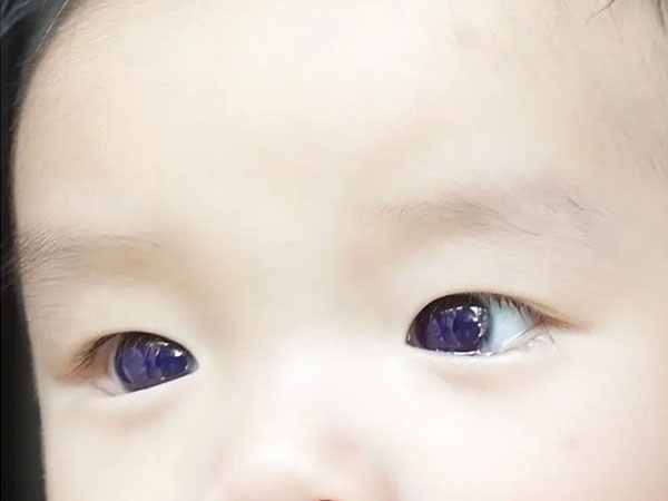 Mắt đổi màu chỉ sau một đêm uống thuốc điều trị bệnh quen thuộc