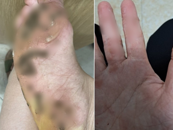 Đi chung dép gia đình 4 người dính hàng trăm 'hạt cơm' gây đau đớn