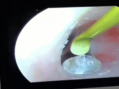 Người phụ nữ bất ngờ phát hiện viên kim cương trong tai mình