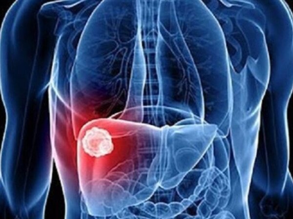 10 dấu hiệu cảnh báo căn bệnh ung thư rất phổ biến tại Việt Nam