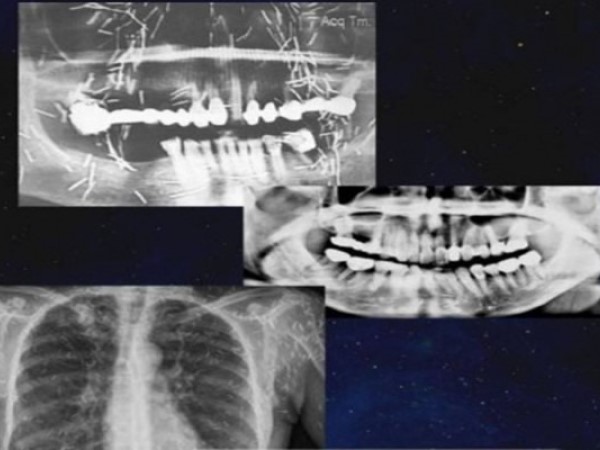 Nữ bệnh nhân đột quỵ, bác sĩ phát hiện chuyện ghê rợn