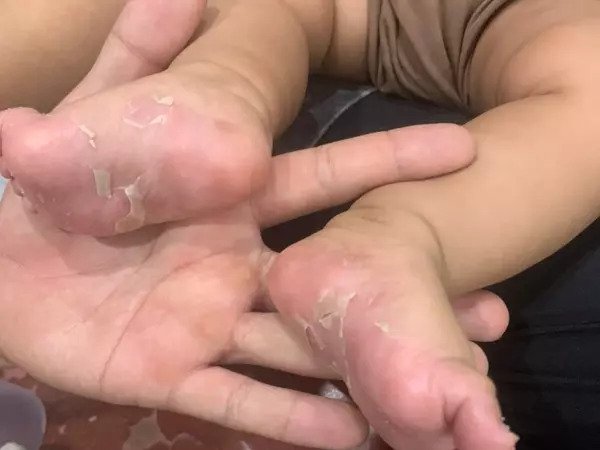Bé trai 3 tháng tuổi mắc giang mai