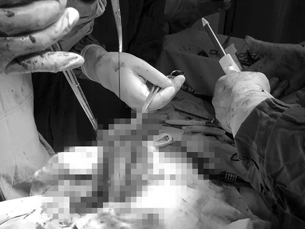 Cô gái 26 tuổi vỡ lách, vỡ dạ dày nguy kịch do gặp nạn sau khi uống rượu