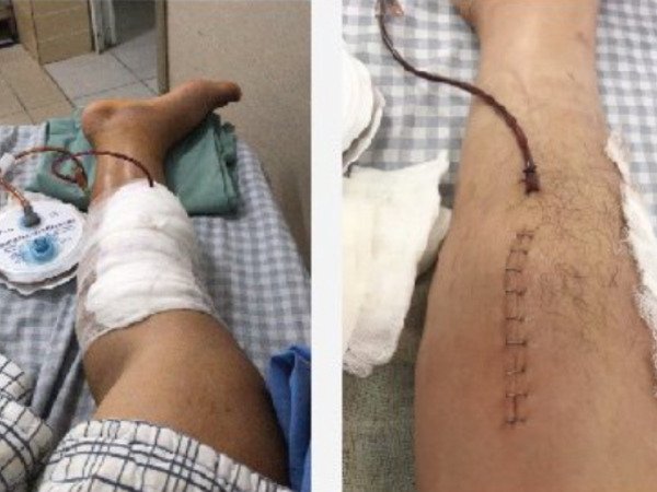 Suýt mất chân khi mới 32 tuổi vì sai lầm nhiều người Việt mắc phải