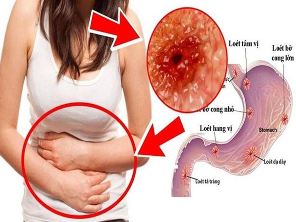Những thực phẩm 'cấm kỵ' với người đau dạ dày