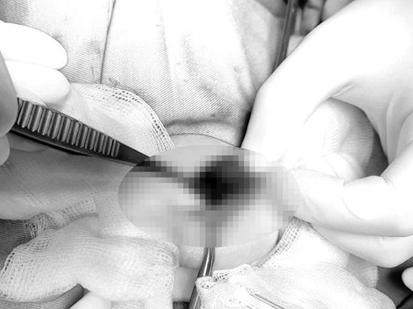 Bé trai 2 tuổi phải cắt bỏ tinh hoàn, bác sĩ cảnh báo ba mẹ đừng chủ quan: Chậm một chút, hỏng cả đời