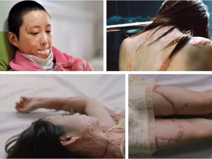 Khúc mắc tình cảm với thiếu gia nhà giàu, cô gái 16 tuổi bị 'hủy dung': Hành trình sống tiếp khó như lên trời