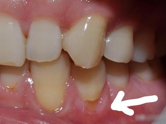 Răng vỡ rụng từng mảng vì cách đánh răng sai nhiều người mắc