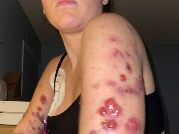 Chi gần 20 triệu tiêm thuốc tan mỡ, cô gái trẻ lở loét toàn thân vì nhiễm virus 'ăn thịt người'