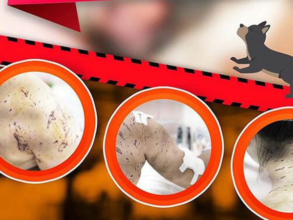 Bé gái 7 tuổi bị 4 con chó lao vào cắn, để lại hàng trăm vết thương