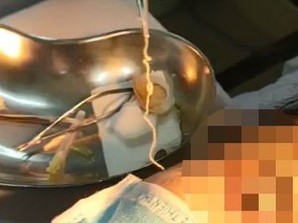 Hi hữu: Phát hiện con giun dài 10cm còn sống trong mắt người phụ nữ