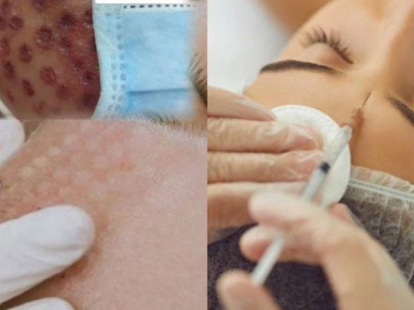 Tưởng tiêm meso căng bóng da, có người đau đớn nhận lại khuôn mặt 'rỗ như tổ ong', ai nhìn cũng phải xót xa