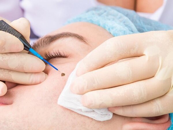 Tẩy nốt ruồi có đổi vận không?
