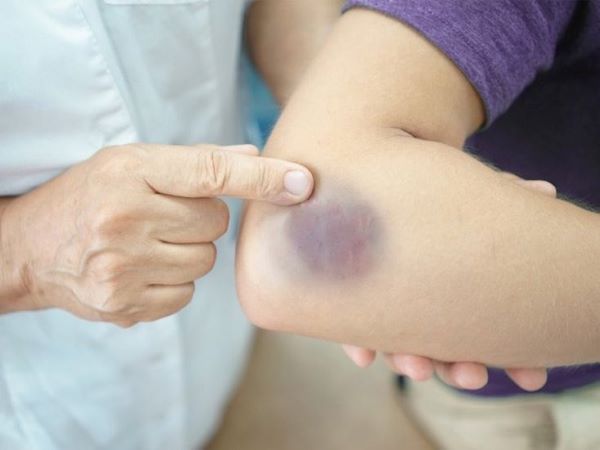Từ vụ Châu Hải My qua đời: Vết bầm tím trên da có thể là dấu hiệu của 7 căn bệnh nguy hiểm này