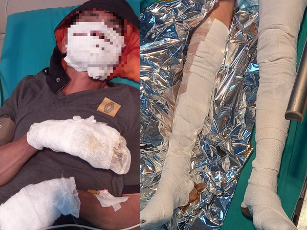 Điện thoại ở đầu giường phát nổ, 2 vợ chồng bị bỏng nặng