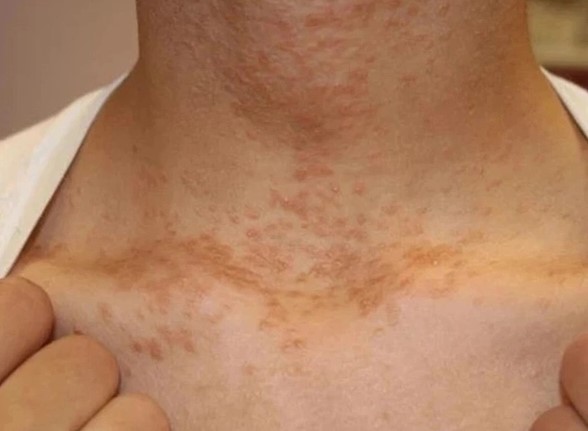 4 bất thường ở cổ cảnh báo ung thư nhưng hầu hết mọi người không để ý