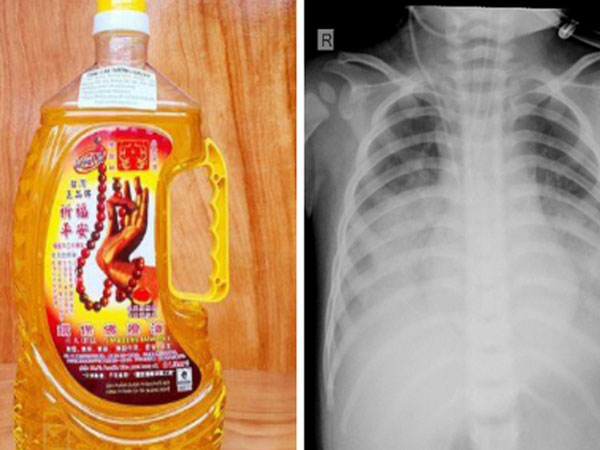 Uống nhầm dầu thắp đèn, bé 15 tháng tuổi nguy kịch