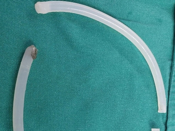 Bác sĩ lôi 40 cm keo nến mắc kẹt trong 'cậu nhỏ'