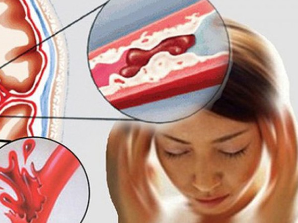 Nữ sinh 15 tuổi bất ngờ đột quỵ ở trường học, trước khi đột quỵ có biểu hiện này!