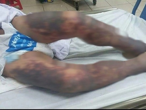 Người đàn ông khoẻ mạnh bất ngờ nguy kịch sau ăn 'món khoái khẩu'