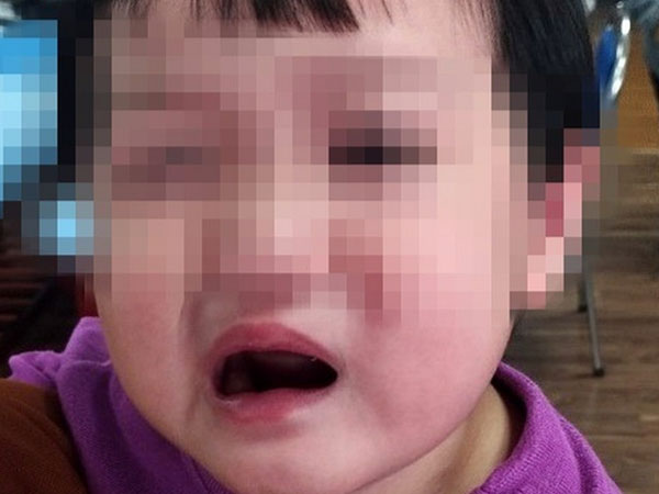 Bé 4 tuổi méo miệng, liệt dây thần kinh số 7 do trời lạnh