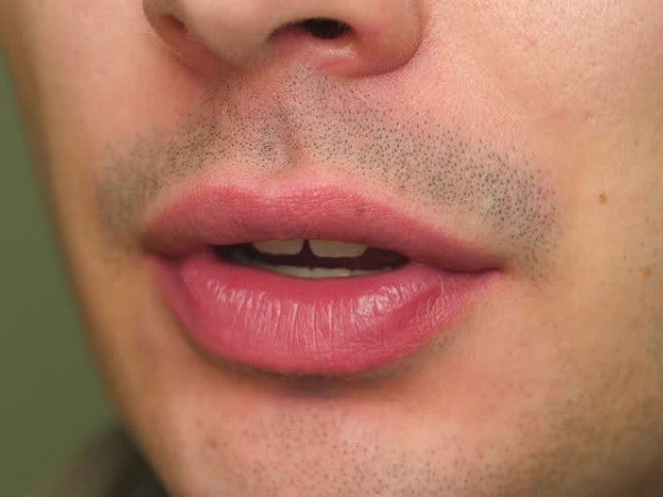 6 cách giúp chàng trị thâm môi cực hiệu quả