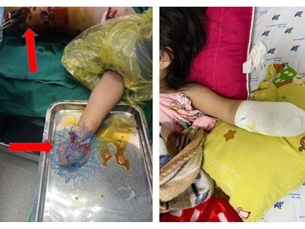Bé gái bị nổ dập nát tay vì nhặt pháo hoa nhà hàng xóm đốt