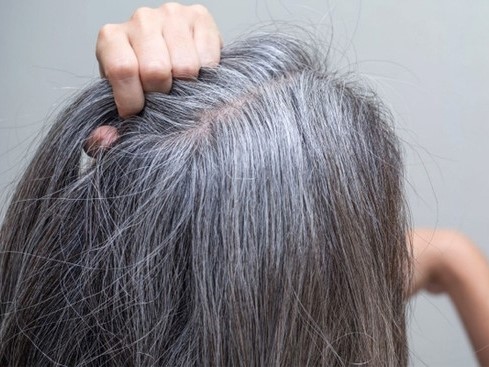 Thực hư căn bệnh khiến tóc đột nhiên bạc trắng