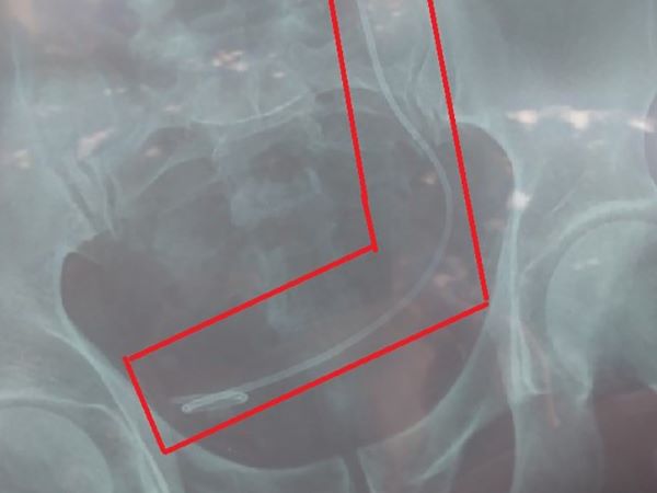 Bác sĩ mổ nhầm bệnh nhân