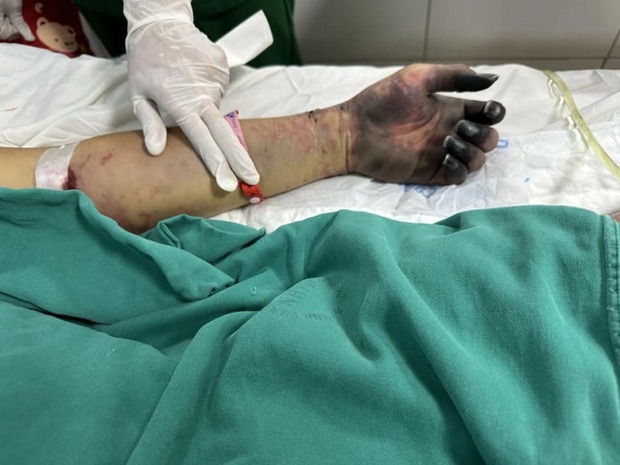 Nam bảo vệ nguy kịch do nhiễm vi khuẩn trong 'món khoái khẩu'